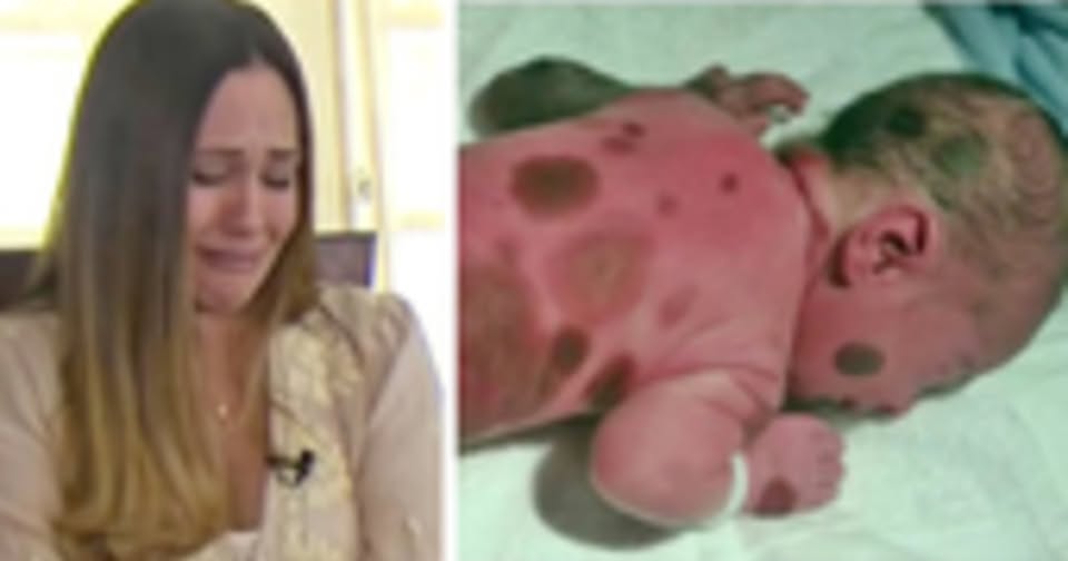 Mom doesn’t dare go outside with baby born with black spots