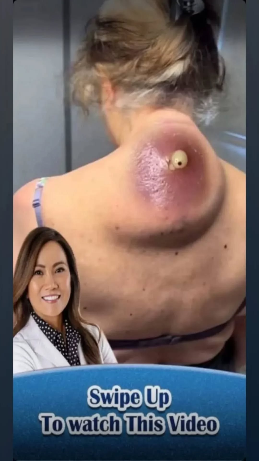 4.. Understanding Skin Cysts: Causes, Treatments, and Medical Advice from Dermatologists