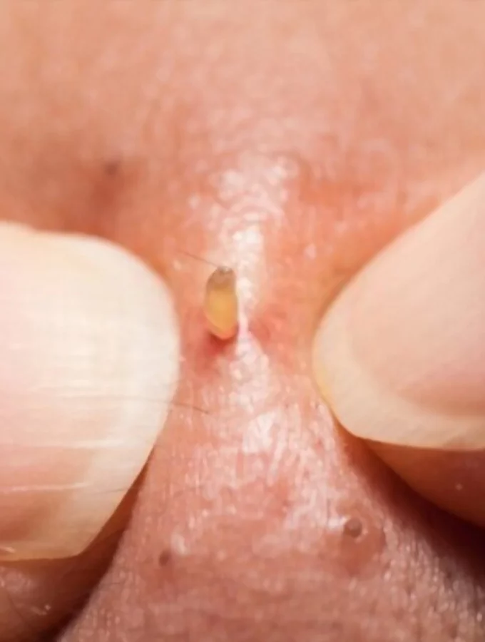 Best 15 Tips For Squeezing Blackheads On Nose