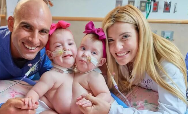 The sisters were born joined at the abdomen, but a year later doctors separated them: this is what the sisters look like today