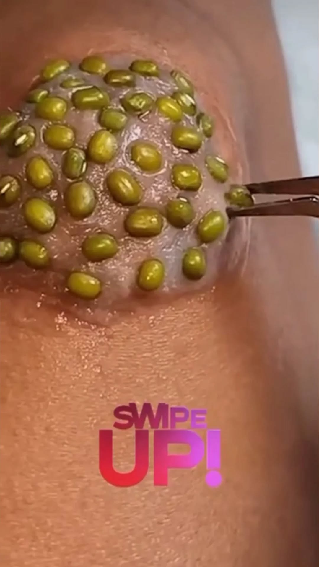 Acne And Everything You Need To Know About Them