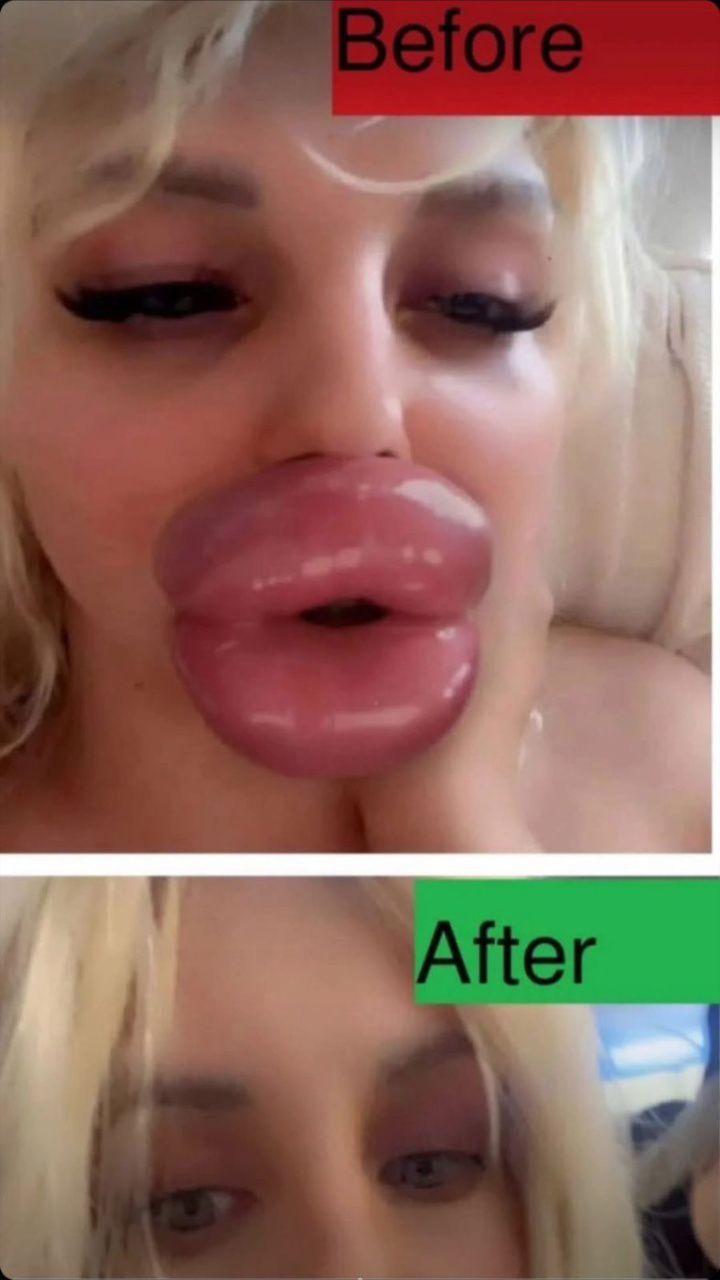 I’ve had so much filler I’m more lips than human – trolls say I look like a duck, but I want them even bigger