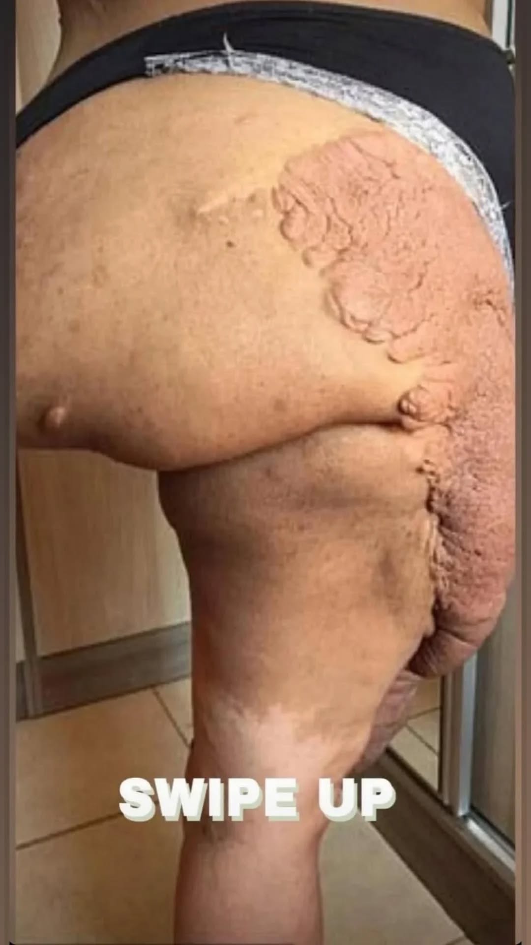Neurofibroma: Understanding Its Origins, Signs, and Treatment Options
