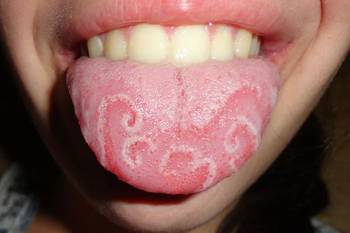 What White Tongue Is, and What to Do About It