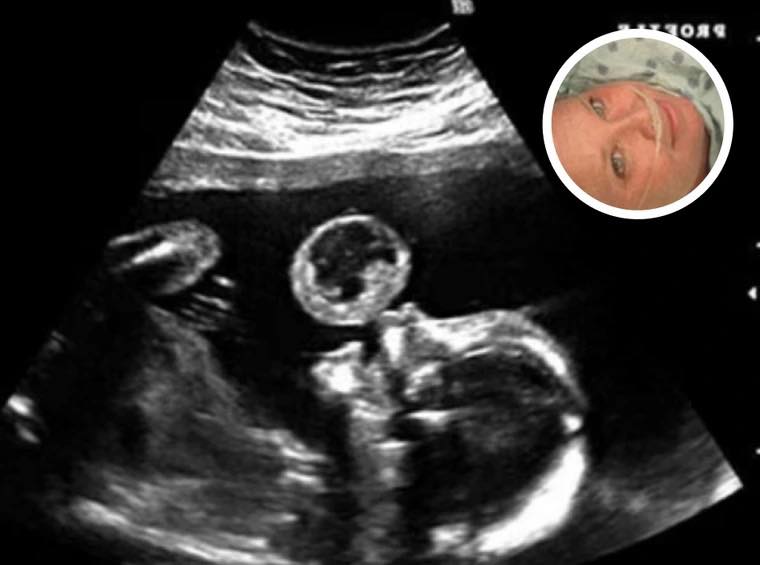 Mom Thinks Her Baby Is Blowing Bubble In Ultrasound, Then Doctors Discover What It Really Is
